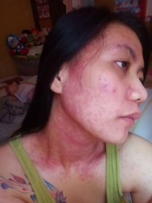 Reguyal shows the rash from using mercury-tainted products last year. Source: Grace Reguyal/Facebook